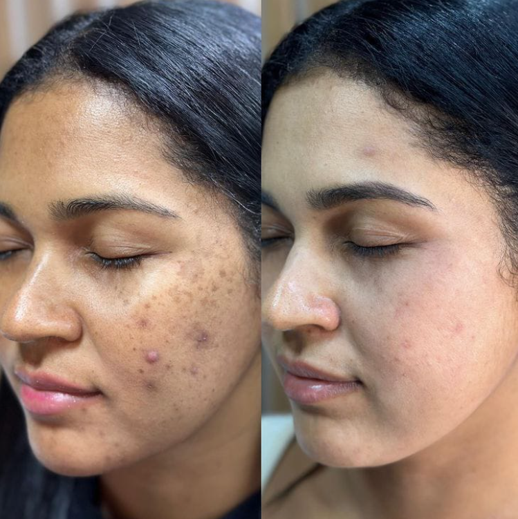 Acne Treatment