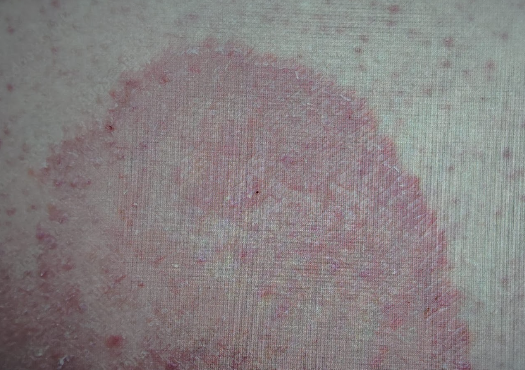 Fungal Infections Treatment