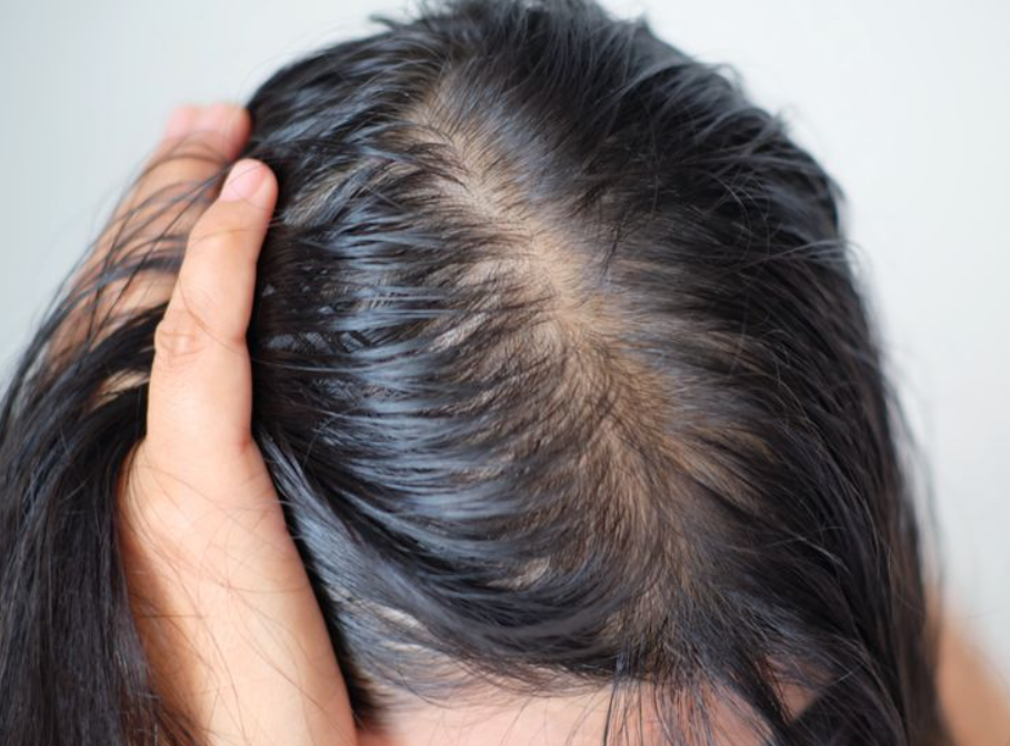 Hair Fall Treatment